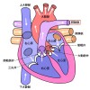肺動脈弁狭窄症